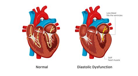 Left Ventricular Diastolic Dysfunction: Causes and Treatments